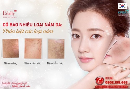 3 Cấp Độ Của Nám Da Và Cách Xử Lý Hiệu Quả