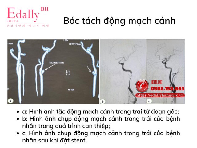 Hình ảnh bóc tác động mạch cảnh Hình ảnh bóc tác động mạch cảnh
