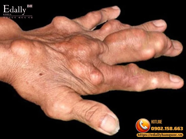 Hình ảnh hạt tophi ở người bệnh gout