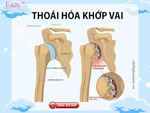 Hình ảnh thoái hóa khớp vai nghiêm trọng