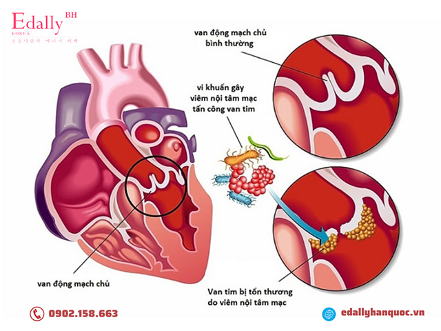 Hở van tim gây viêm nội tâm mạc nhiễm trùng