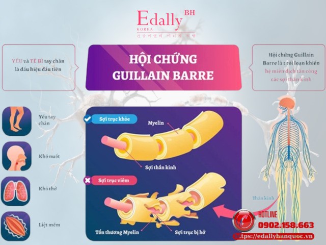 Hội Chứng Guillain-Barré - Hiểu Rõ Để Phòng Tránh Và Ứng Phó Kịp Thời