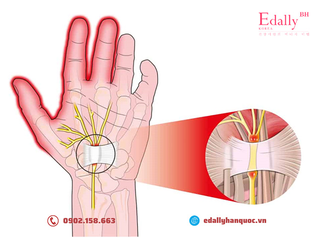 Hội chứng chèn ép dây thần kinh gây ra tê tay trái thường xuyên