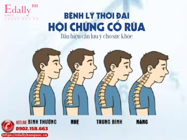 Hội Chứng Cổ Rùa: Bệnh Lý Thời Đại 5.0 - Dấu Hiệu Sức Khỏe Cần Lưu Ý