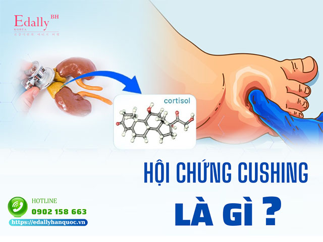 Hội chứng Cushing là gì và có nguy hiểm không?