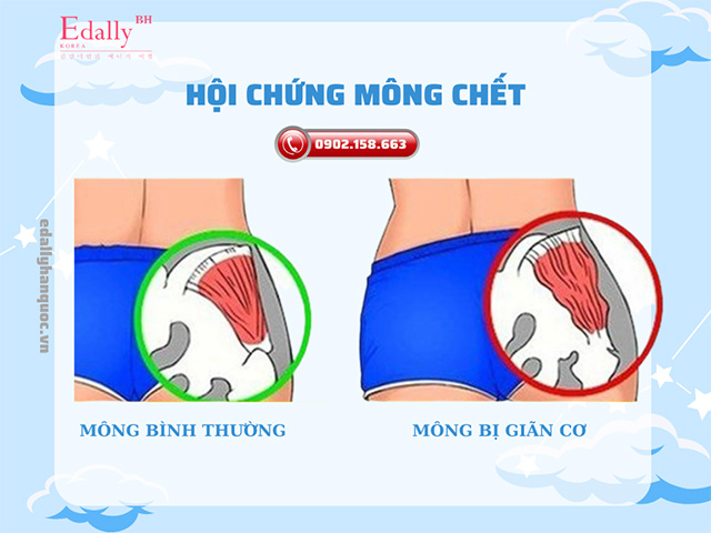 Hội chứng mông chết và cách phòng ngừa hiệu quả