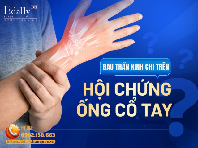 Hội chứng ống cổ tay là chứng đau thần kinh chi trên thường gặp