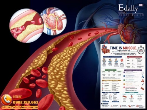 Hội Chứng Vành Cấp (Acute Coronary Syndrome - ACS): Time is Muscle - Nhận Diện Sớm, Chẩn Đoán Chính Xác