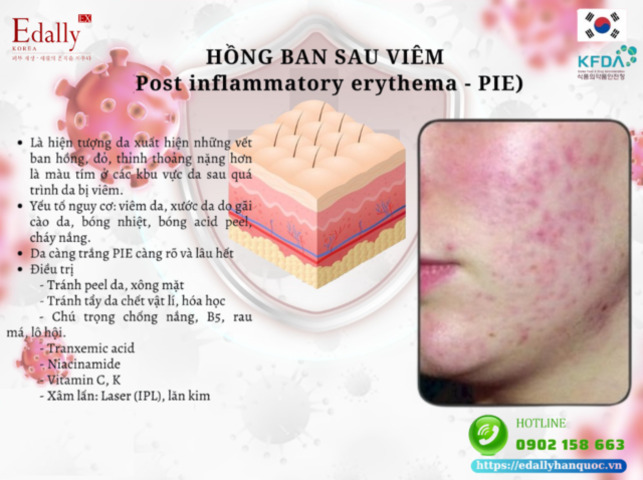 Hồng ban sau viêm (hay còn được gọi là thâm đỏ sau mụn)