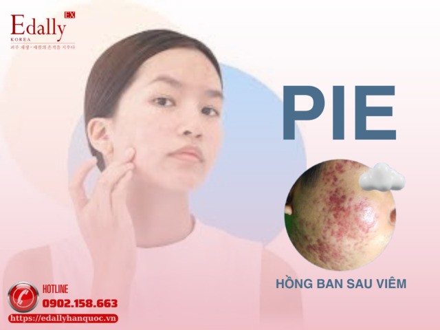 Hồng Ban Sau Viêm: Những Mảng Đỏ Phiền Phức Sau Mụn Và Cách Điều Trị