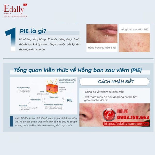 Hồng ban sau viêm (PIE) là gì?