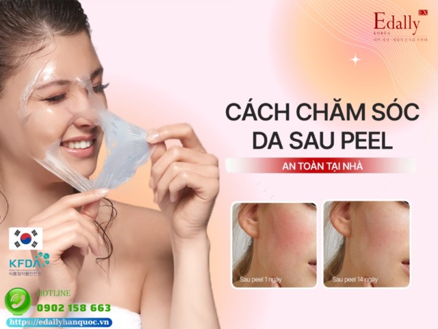 Hướng dẫn cách chăm sóc da sau peel tại nhà một cách hiệu quả, an toàn