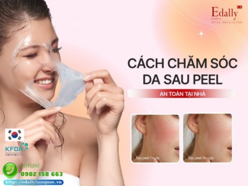 Hướng Dẫn Cách Chăm Sóc Da Sau Peel Tại Nhà