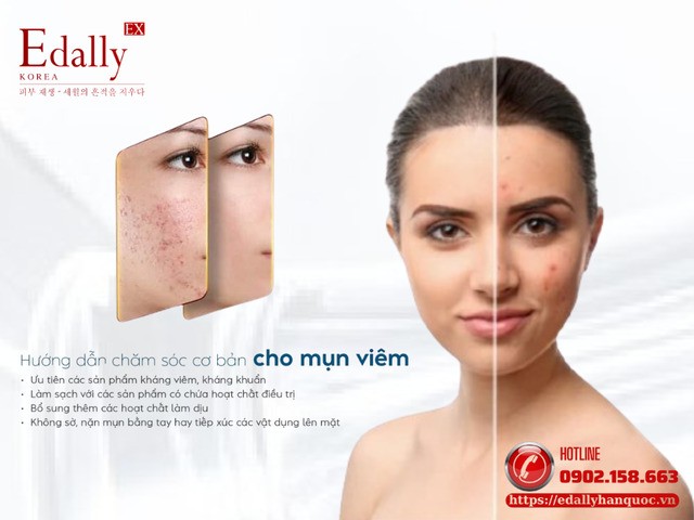 Cách chăm sóc cơ bản cho mụn viêm an toàn và hiệu quả