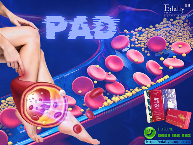 Hướng dẫn điều trị bệnh động mạch chi dưới (PAD)