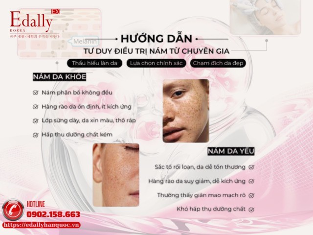 Hướng dẫn tư duy điều trị nám da từ chuyên gia da liễu