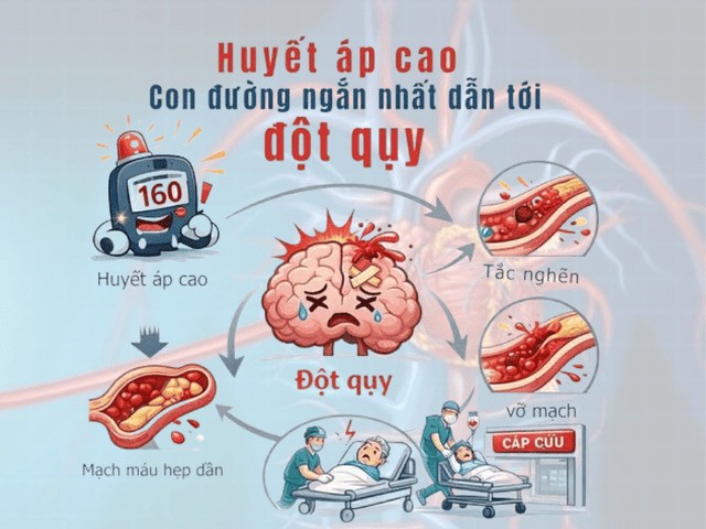 Huyết áp cao kiểm soát kém - Con đường ngắn nhất dẫn đến đột quỵ