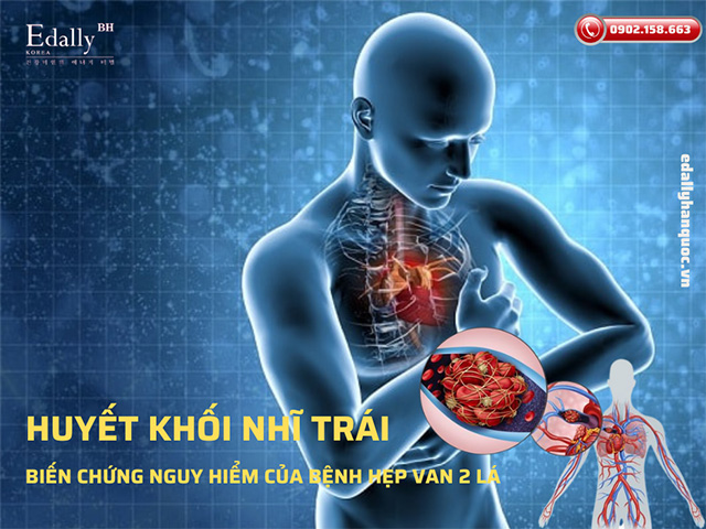 Huyết khối nhĩ trái là biến chứng nguy hiểm của bệnh hẹp van hai lá