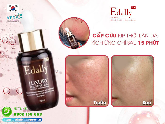 Huyết thanh tổ yến Edally EX - Cấp cứu làn da bị kích ứng chỉ trong 15 phút