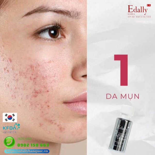 Kem Retinol Edally EX Hàn Quốc có thể dẹp bỏ làn da mụn xấu xí