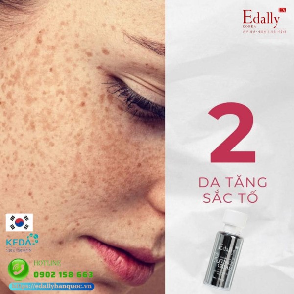 Kem Retinol Edally EX Hàn Quốc có thể dẹp bỏ làn da tăng sắc tố