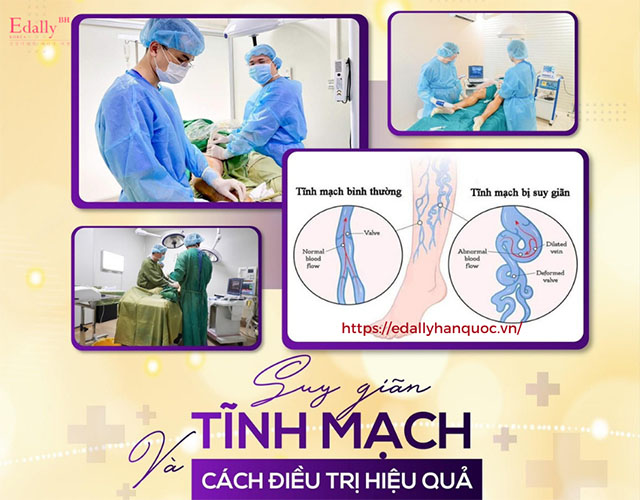 Kết hợp giữa Đông - Tây y để hiệu quả tốt nhất khi điều trị giãn tĩnh mạch chân tại nhà 