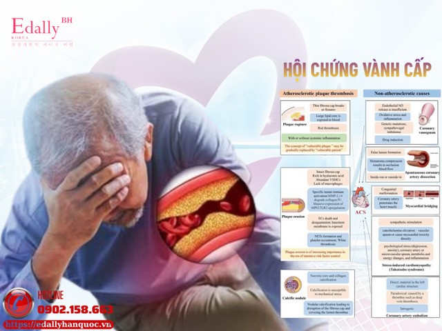 Khái niệm mới trong sinh lý bệnh hội chứng vành cấp