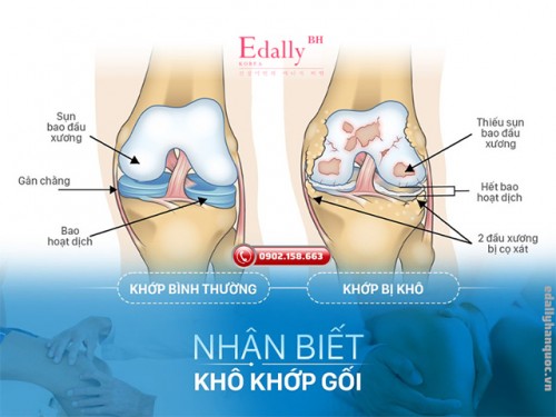 Khô Dịch Khớp - Căn Nguyên Sâu Xa Gây Ra Hàng Trăm Bệnh Lý 