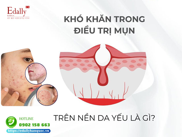 Khó khăn trong việc điều trị mụn trên nền da yếu là gì?