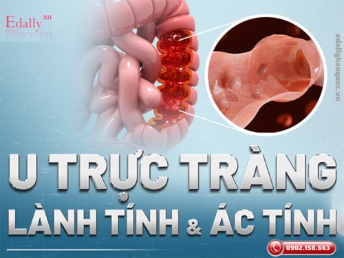 Khối U Trực Tràng Lành Tính Và Ác Tính Khác Nhau Như Thế Nào?