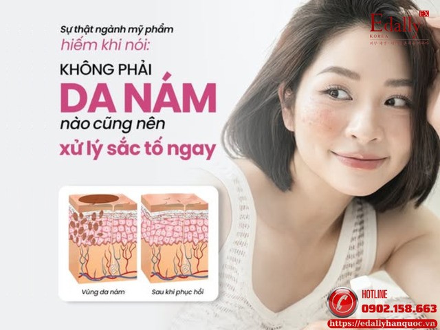 Sự thật ngành mỹ phẩm hiếm khi nói - Không phải làn da nám sau sinh nào cũng nên xử lý sắc tố ngay Sự thật ngành mỹ phẩm hiếm khi nói - Không phải làn da nám sau sinh nào cũng nên xử lý sắc tố ngay