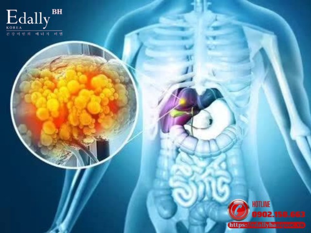 Khuyến cáo mới về sàng lọc và can thiệp sớm bệnh gan liên quan đến chuyển hóa ở bệnh nhân đái tháo đường