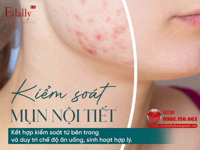 Mụn Nội Tiết: Hướng Kiểm Soát Và Gợi Ý Phác Đồ