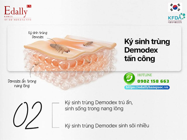 Khi da nghiện corticoid sẽ tạo điều kiện cho ký sinh trùng demodex tấn công