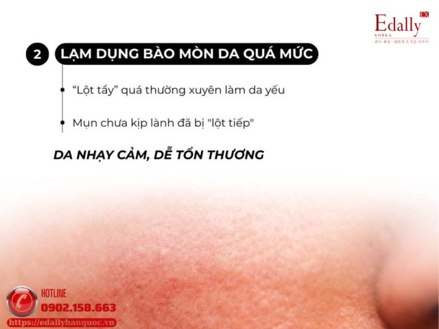 Lạm dụng bào mòn da quá mứckhi kết hợp sản phẩm trị mụn khiến mụn ngày càng tệ hơn