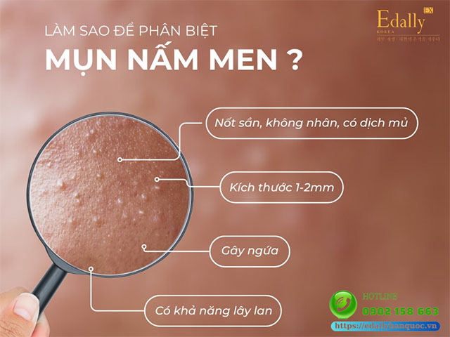 Làm sao để nhận biết mụn nấm men?