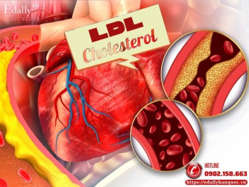 Làm Thế Nào Để Giảm Cholesteron Xấu LDL Trong Máu?