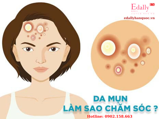 Da bị mụn thì phải làm sao?