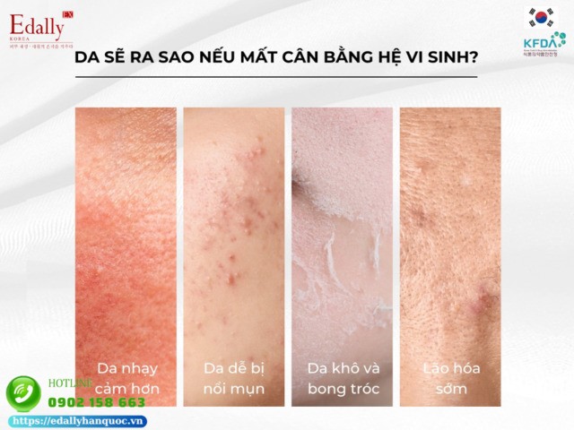 Khi mất cân bằng hệ vi sinh microbiome trên da thì làn da sẽ ra sao?