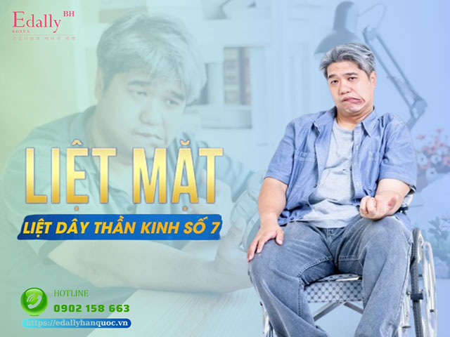 Liệt Mặt Ngoại Biên - Cần Làm Gì Khi Bạn Hoặc Người Thân Gặp Phải?