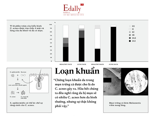 Chứng loạn khuẩn da trong mụn trứng cá ở người trưởng thành