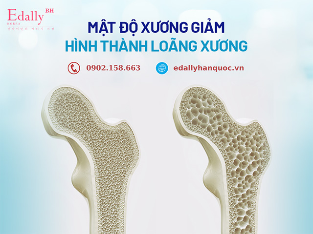 Loãng xương là tình trạng mật độ xương giảm