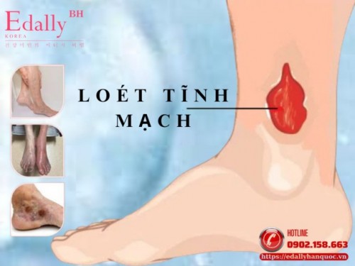 Loét Tĩnh Mạch: Nguyên Nhân, Triệu Chứng Và Cách Phòng Ngừa Hiệu Quả