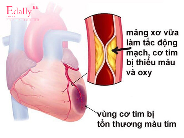 Mạch máu tắc nghẽn làm động mạch, cơ tim bị thiếu máu và oxy