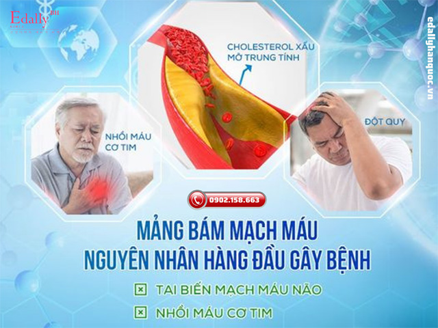 Mảng bám mạch máu là nguyên nhân chính gây ra nhồi máu cơ tim