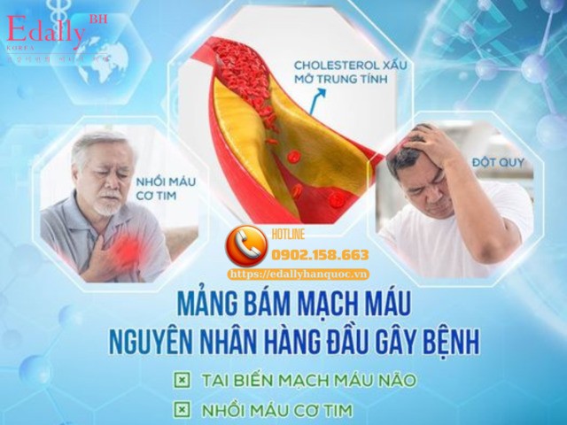Mảng bám mạch máu là nguyên nhân hàng đầu gây bệnh lý tim mạch và đột quỵ