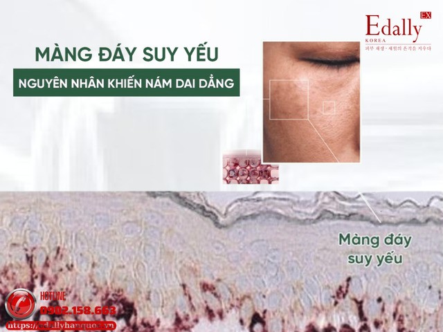Màng đáy suy yếu - nguyên nhân khiến nám da dai dẳng
