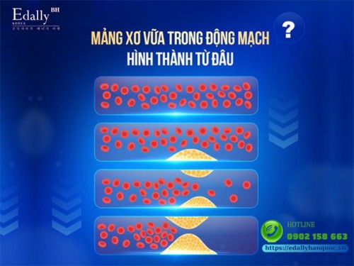 Mảng Xơ Vữa Trong Động Mạch Hình Thành Từ Đâu?