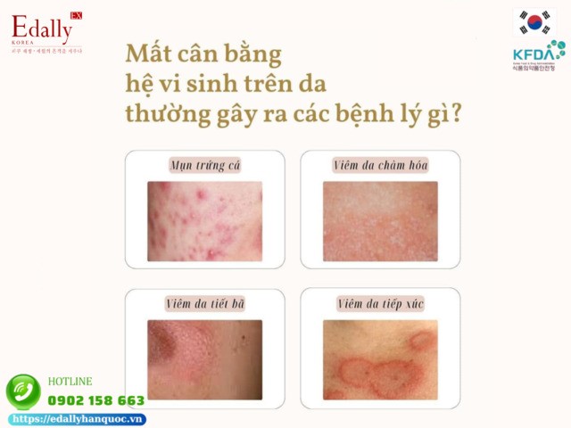 Mất cân bằng hệ vi sinh vật trên da thường gây ra các bệnh lý gì về da?