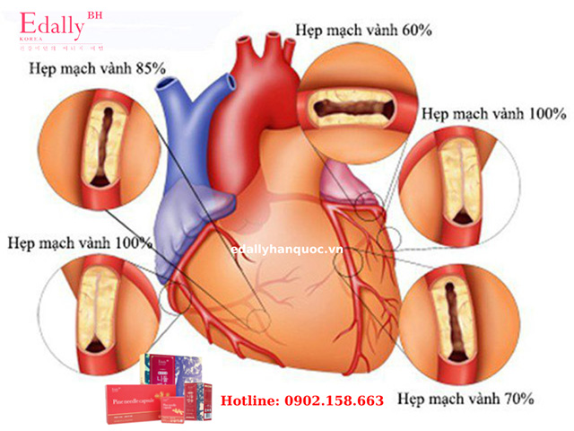 Mỡ máu cao là nguyên nhân chính gây ra bệnh mạch vành